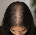 Female Hair Thinning