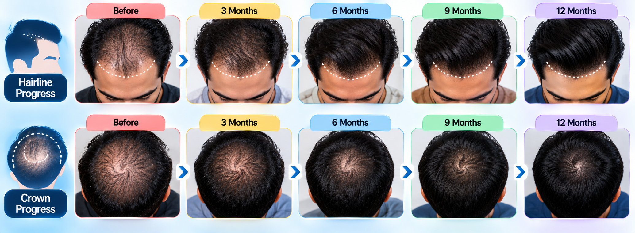 Pattern hair loss progress tracking with hairline and crown photos over time