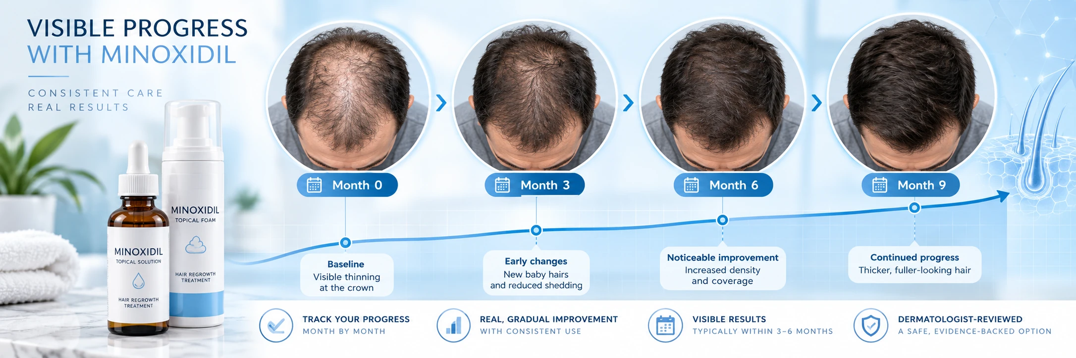 Minoxidil progress tracking visual showing hair density changes from baseline through 3, 6 and 9 months
