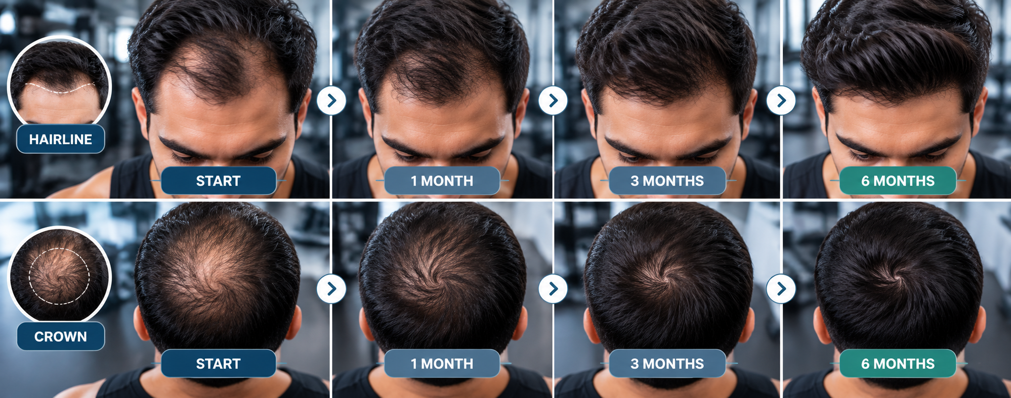Gym hair loss progress with hairline and crown photos