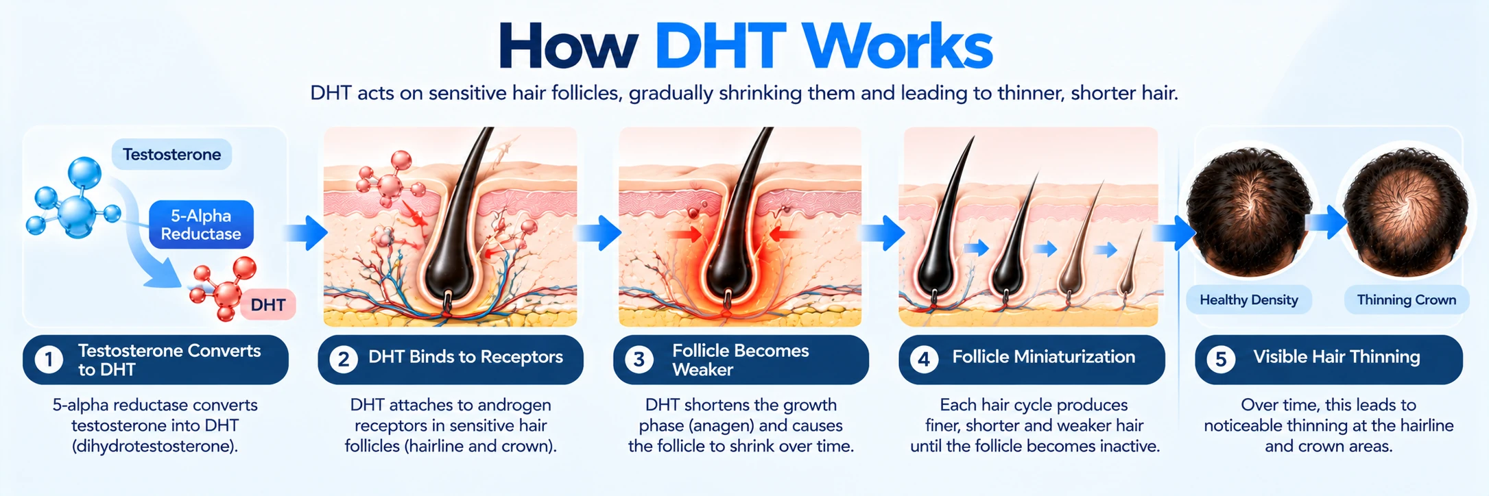 How DHT Works and Causes Hair Loss Diagram showing how testosterone converts to DHT, binds to hair follicle receptors, causes follicle miniaturization, and leads to crown thinning.