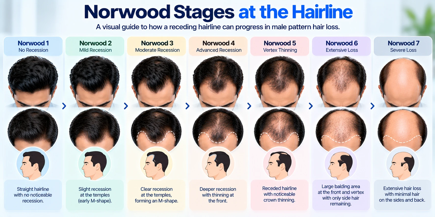 Norwood stages showing progression of a receding hairline from mild temple recession to advanced male pattern hair loss.