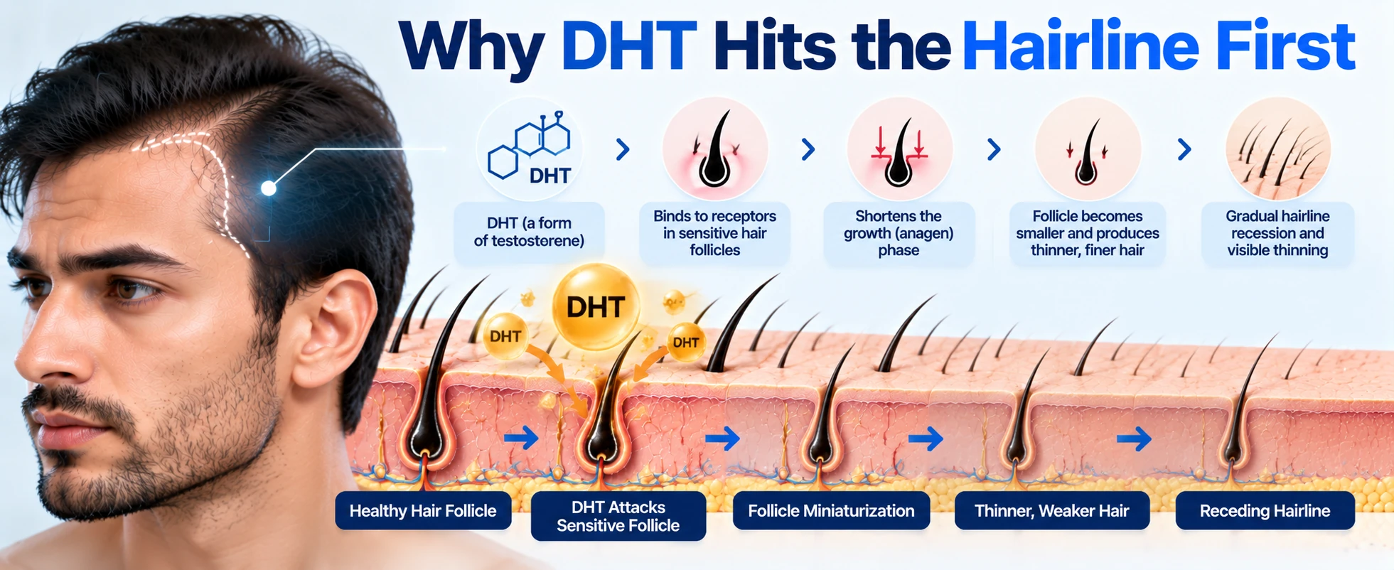 Diagram showing how DHT affects sensitive hair follicles at the hairline, causing follicle miniaturization, thinner hair, and gradual hairline recession.