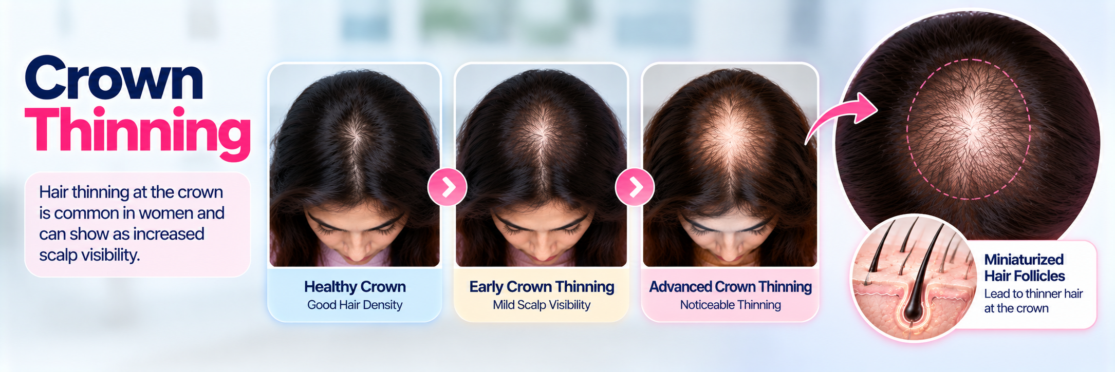 Crown thinning in women showing reduced density and increasing scalp visibility over the top of the head