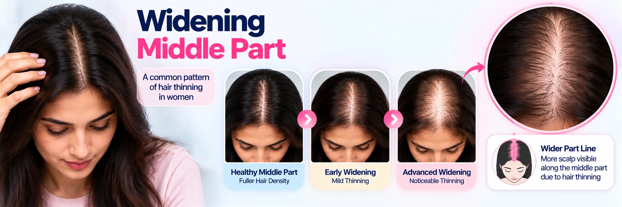 Widening middle part in women showing progression from a normal part to increased scalp visibility and advanced hair thinning